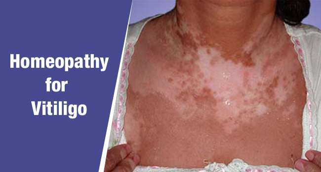 Homeopathy For Treatment Of Vitiligo