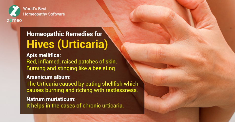 Homeopathic Remedies For Hives (Urticaria) | Hompath